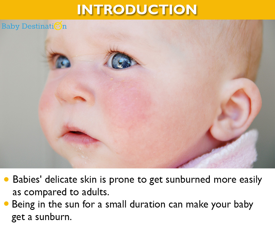 Home Remedies To Cure Sunburn In Babies