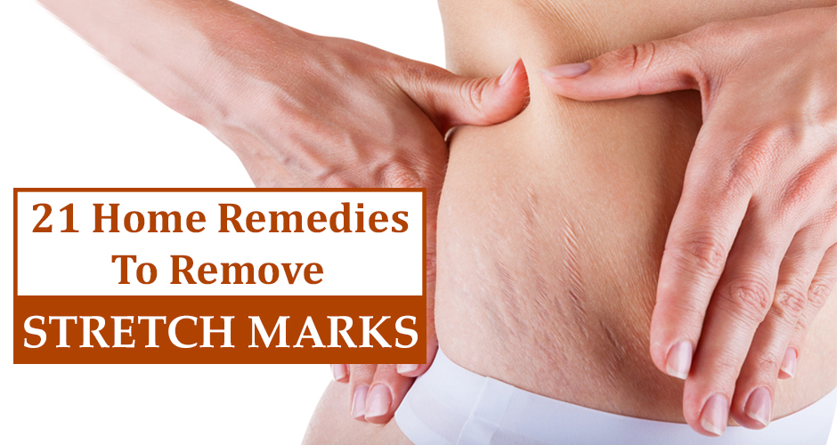 21 Simple Home Remedies To Get Rid Of Pregnancy Stretch Marks