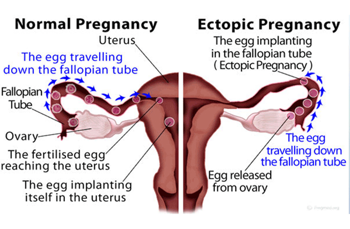 Vaginal Bleeding And Spotting During Pregnancy What It Means