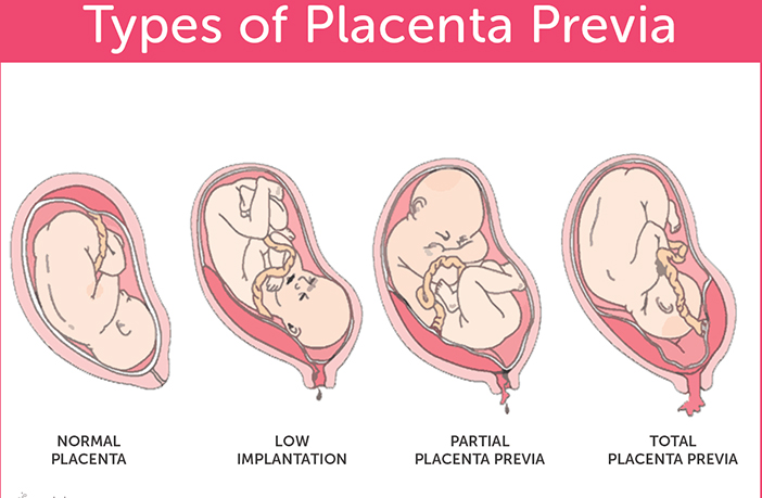 What could bleeding mean in pregnancy? Should I visit to the doctor?