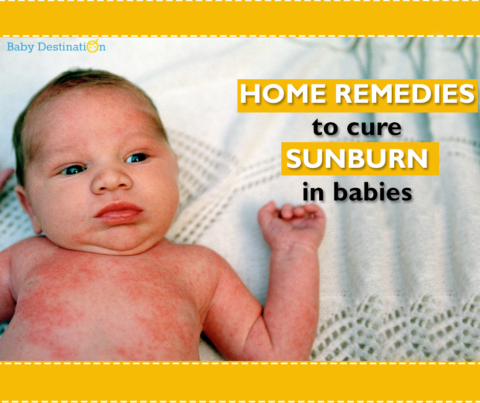 Home Remedies To Cure Sunburn In Babies