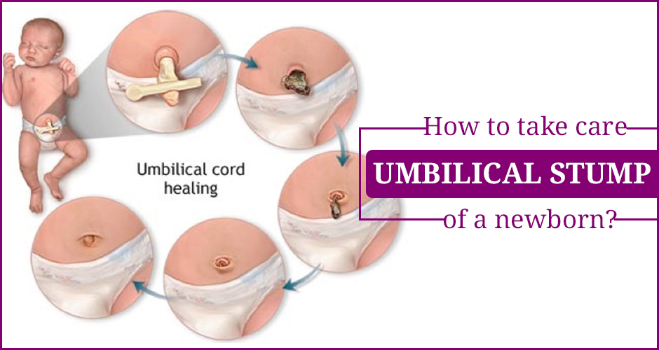 How To Take Care Umbilical Stump Of A Newborn?