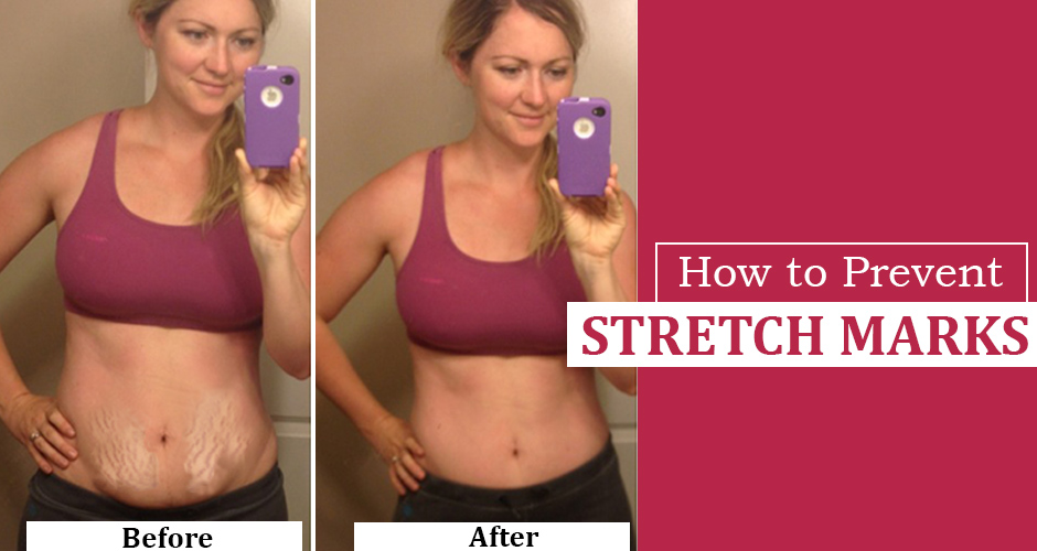 3 Most Effective ways to Prevent Stretch Marks
