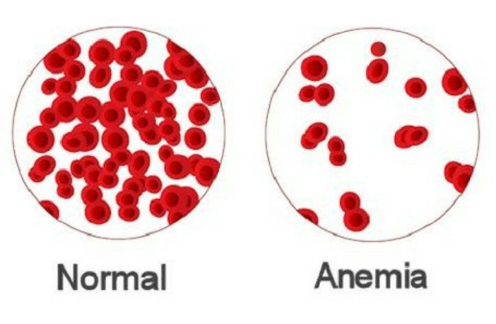pregnancy-anemia