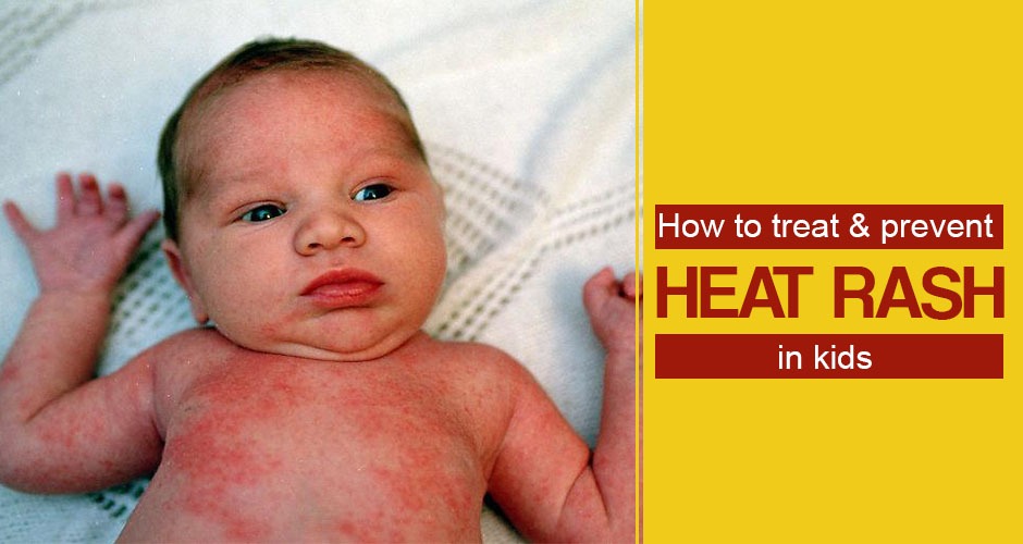 How To Treat And Prevent Heat Rash In Kids
