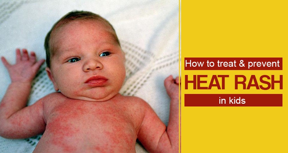 How To Treat A Baby Rash Continental Clinic