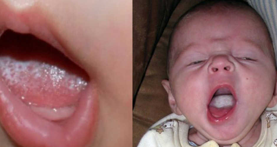 oral candidiasis in infants