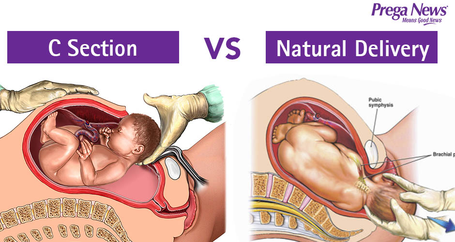 C-section versus Natural Delivery - Risks and Benefits