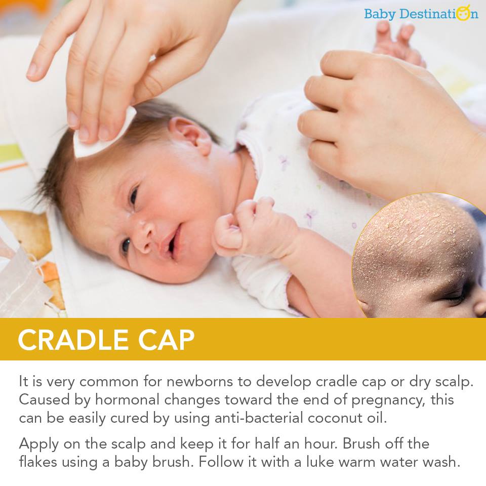 cradle cap treatment coconut oil