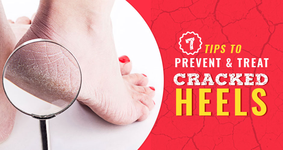 7 Tips to Prevent and Treat Cracked Heels