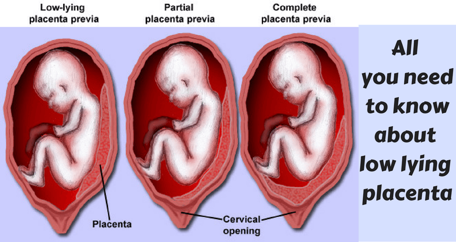 All that you need to know about Low Lying Placenta during Pregnancy