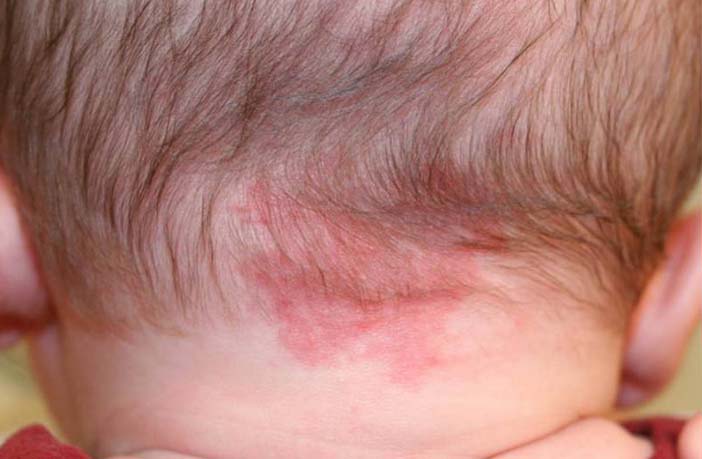 Birthmarks in Babies - Myths and Facts