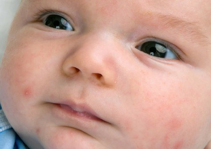 baby acne 