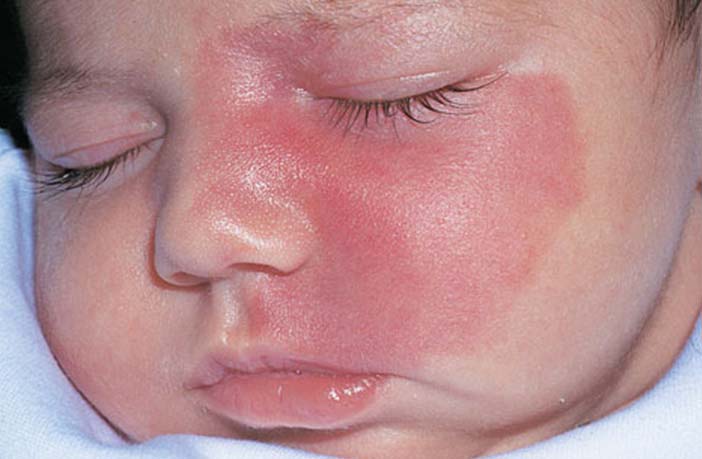 does-your-baby-has-birthmarks-here-are-some-myths-and-facts