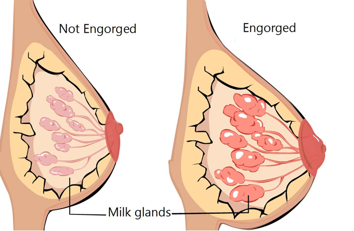 10 effective ways to reduce swollen breasts