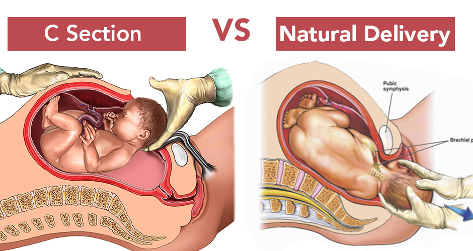 C section versus Natural Delivery - Risks and Benefits