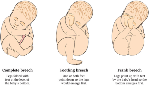 Different Types Of Birth Positions & How To Correct Them For Delivery