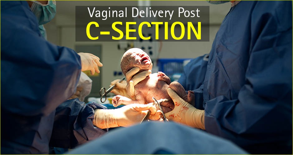 c-sections multiple Vaginal after borth