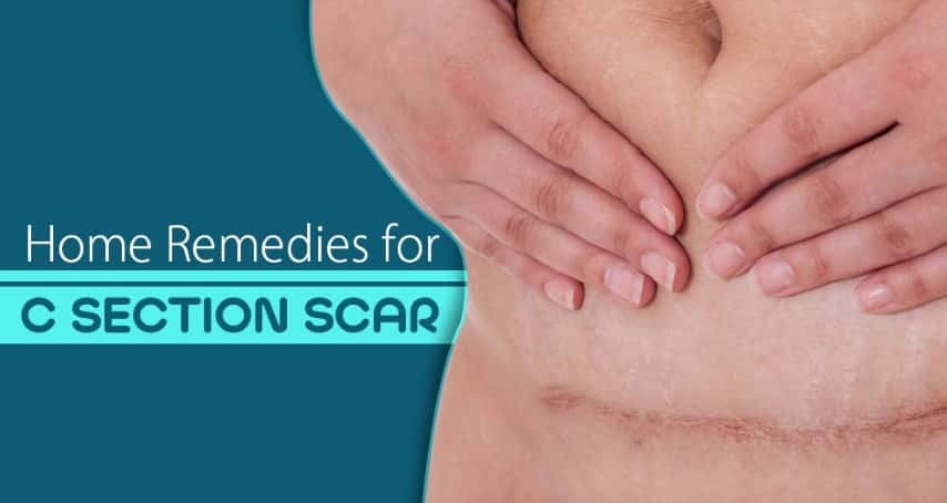 Effective Home Remedies For C-Section Scars