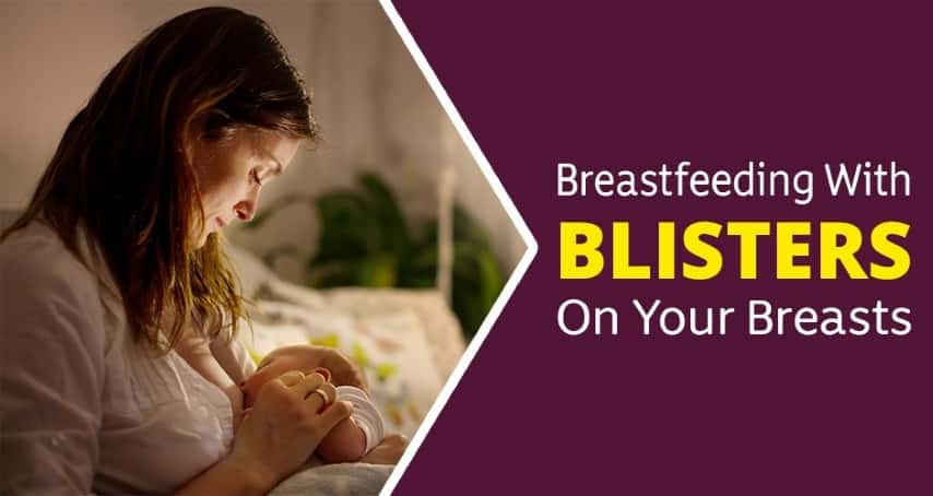 10 Tips for Breastfeeding with a Blister on your Breast
